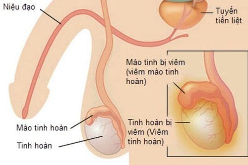 Nguyên nhân gây ra đau tinh hoàn bên trái